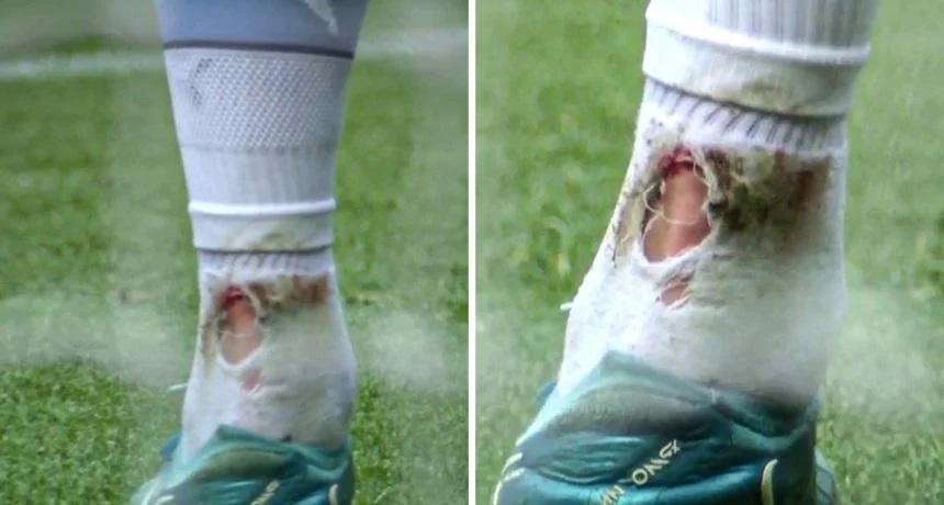 Haaland's ankle